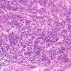 12E2 Plasmacytoma (Case 12) ISH Kappa 10X