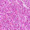 14A1 Plasmacytoma (Case 14) H&E 40X 2