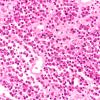 14A2 Plasmacytoma (Case 14) H&E 40X 4