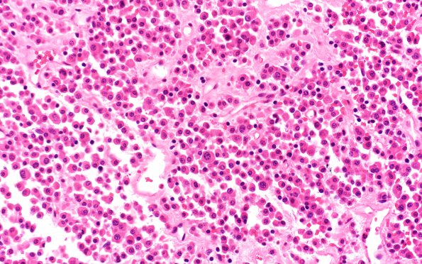 14A2 Plasmacytoma (Case 14) H&E 40X 4