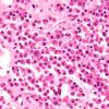 14A3 Plasmacytoma (Case 14) H&E 60X 2