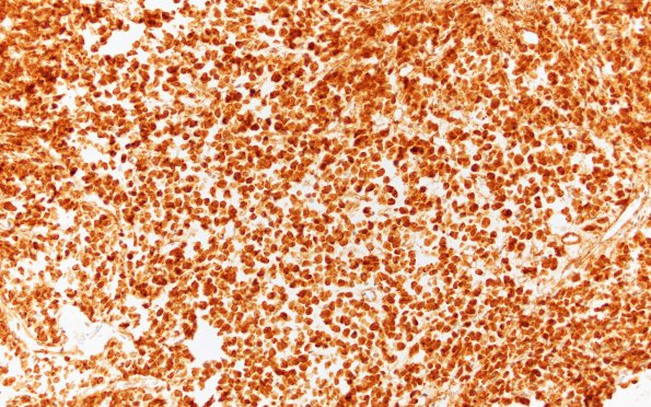 14B1 Plasmacytoma (Case 14) Kappa 20X