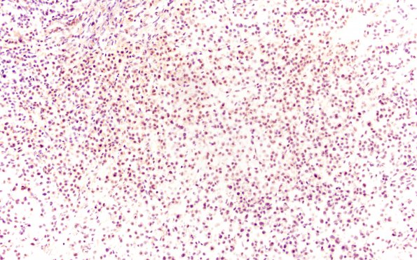 14B2 Plasmacytoma (Case 14) Lambda 20X