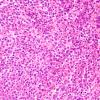 15A1 Myeloid sarcoma (looks like plasmacytoma) (Case 15) H&E 3