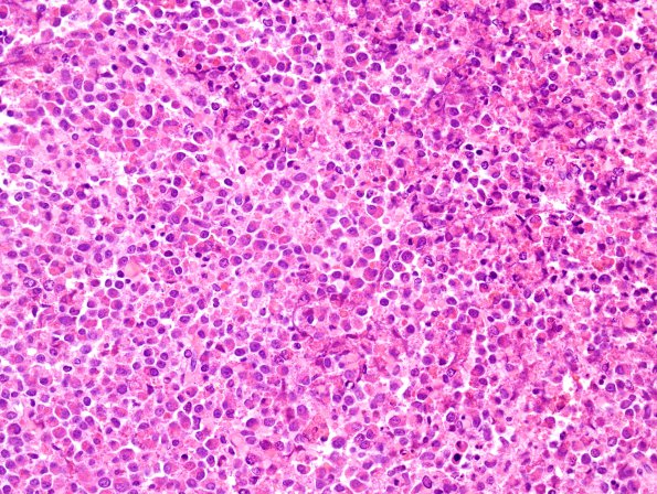 15A1 Myeloid sarcoma (looks like plasmacytoma) (Case 15) H&E 3