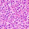 15A2 Myeloid sarcoma (looks like plasmacytoma) (Case 15) H&E 100X 5