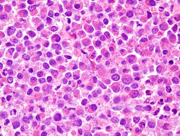 15A2 Myeloid sarcoma (looks like plasmacytoma) (Case 15) H&E 100X 5