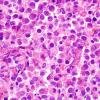 15A3 Myeloid sarcoma (looks like plasmacytoma) (Case 15) H&E 100X 2