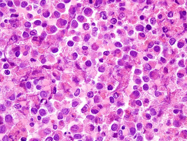 15A3 Myeloid sarcoma (looks like plasmacytoma) (Case 15) H&E 100X 2