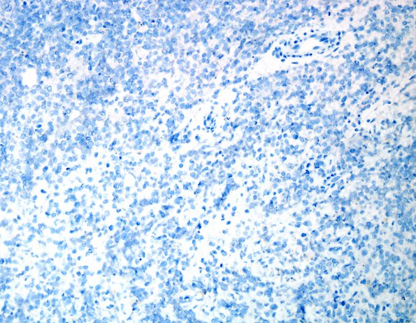 15B Myeloid sarcoma (looks like plasmacytoma) (Case 15) CD138 2