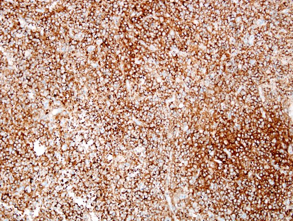 15C1 Myeloid sarcoma (looks like plasmacytoma) (Case 15) CD4 2