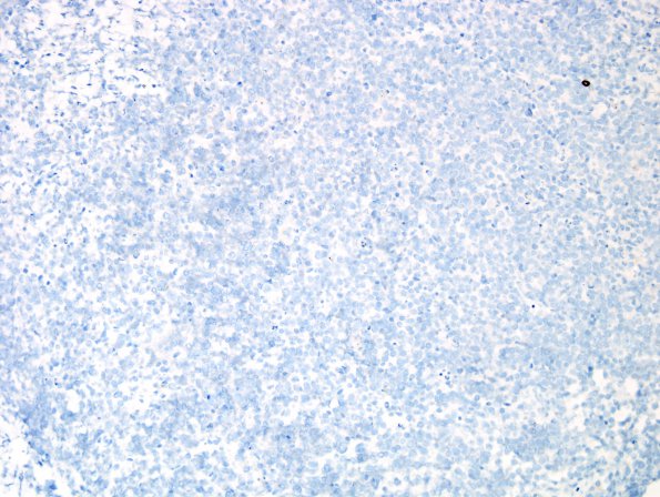 15C2 Myeloid sarcoma (looks like plasmacytoma) (Case 15) CD20 2