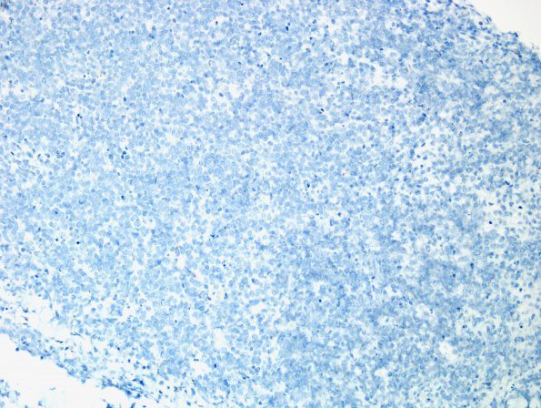 15C3 Myeloid sarcoma (looks like plasmacytoma) (Case 15) CD79a 2