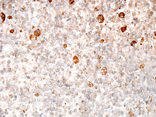 15D Myeloid sarcoma (looks like plasmacytoma) (Case 15) CD68 1