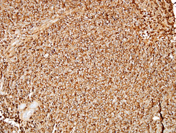 15E1 Myeloid sarcoma (looks like plasmacytoma) (Case 15) Myeloperoxidase (MPX) 2