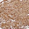 15F Myeloid sarcoma (vs AML, looks like plasmacytoma) (Case 15) Lysozyme 2