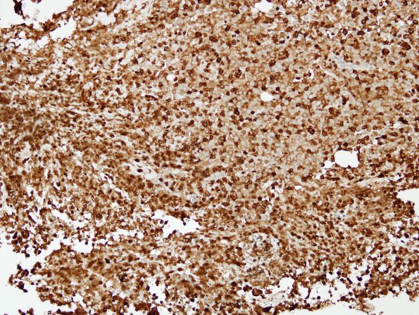 15F Myeloid sarcoma (vs AML, looks like plasmacytoma) (Case 15) Lysozyme 2