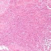 15G1 Myeloid sarcoma (looks like plasmacytoma) (Case 15) ISH Kappa 1