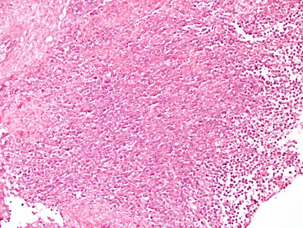 15G1 Myeloid sarcoma (looks like plasmacytoma) (Case 15) ISH Kappa 1