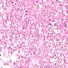 15G2 Myeloid sarcoma (looks like plasmacytoma) (Case 15) ISH Lambda 1