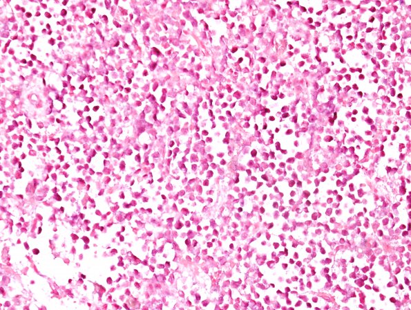 15G2 Myeloid sarcoma (looks like plasmacytoma) (Case 15) ISH Lambda 1