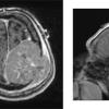 1A Plasmacytoma (Case 1) T1W & localizer - Copy