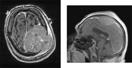 1A Plasmacytoma (Case 1) T1W & localizer - Copy