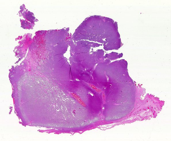 1B1 Plasma Cell Dyscrasia (S08-50994) H&E WM