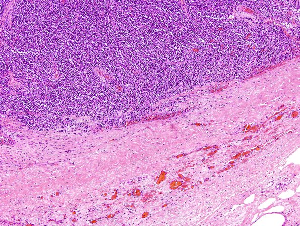 1B2 Plasma Cell Dyscrasia (Case 1) H&E 4