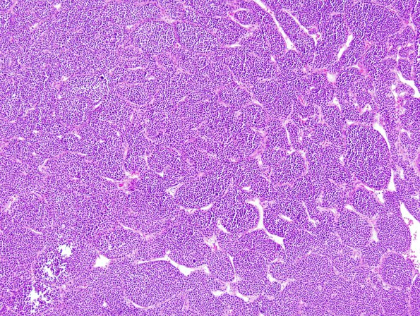 1B3 Plasmacytoma (Case 1) 1.jpg