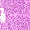 1B4 Plasmacytoma (Case 1) H&E B4 20X