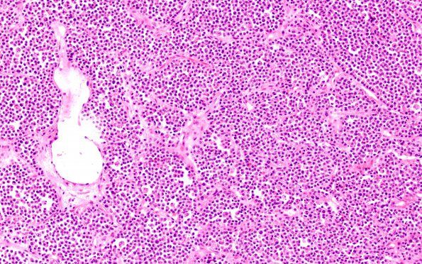 1B4 Plasmacytoma (Case 1) H&E B4 20X