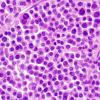 1B7 Plasmacytoma (Case 1) 5.jpg