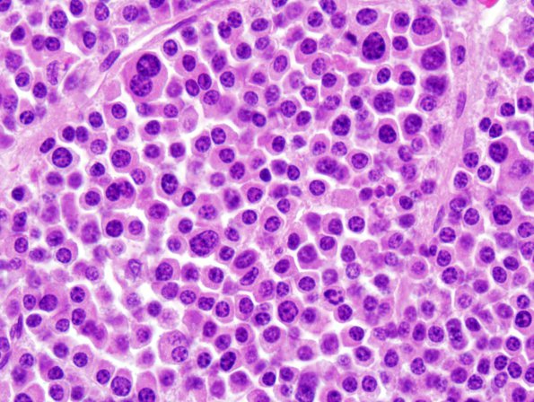 1B7 Plasmacytoma (Case 1) 5.jpg