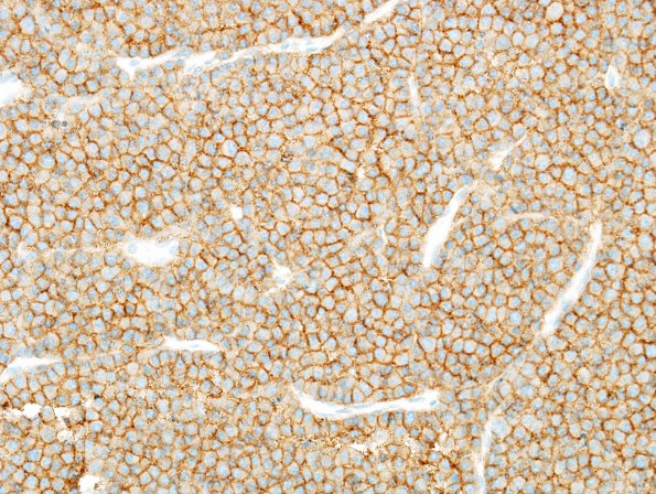 1C Plasmacytoma (Case 1) CD138 1