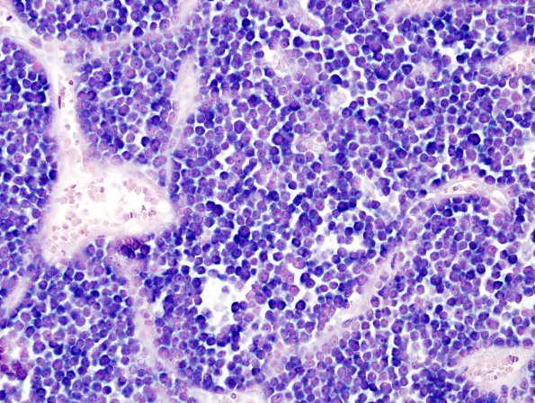 1D1 Plasmacytoma (Case 1) ISH kappa 1