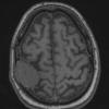 2A1 Plasmacytoma (Case 2) T1noC - Copy