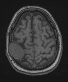 2A1 Plasmacytoma (Case 2) T1noC - Copy