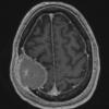 2A2 Plasmacytoma (Case 2) T1W - Copy