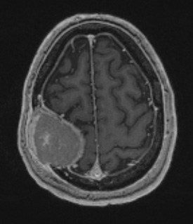 2A2 Plasmacytoma (Case 2) T1W - Copy