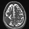 2A3 Plasmacytoma (Case 2) T2W - Copy