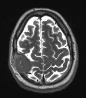 2A3 Plasmacytoma (Case 2) T2W - Copy