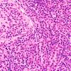 2B1 Plasmacytoma (Case 2) H&E 3