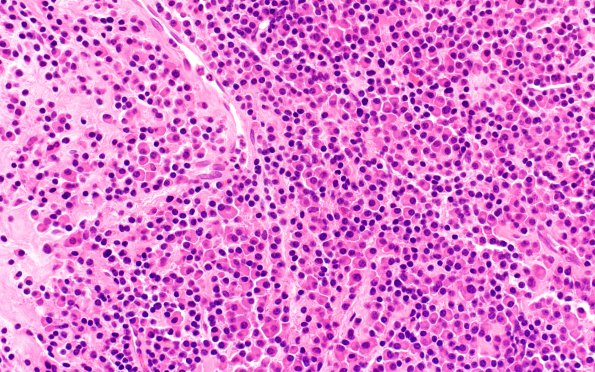 2B1 Plasmacytoma (Case 2) H&E 3