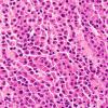 2B2 Plasmacytoma (Case 2) H&E 5