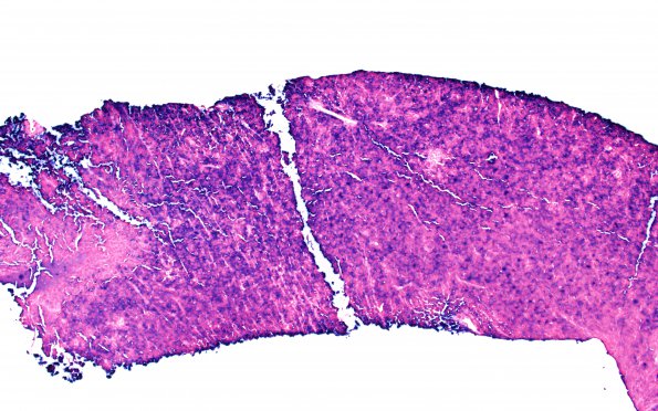 2D1 Plasmacytoma (Case 2) ISH Kappa 10X