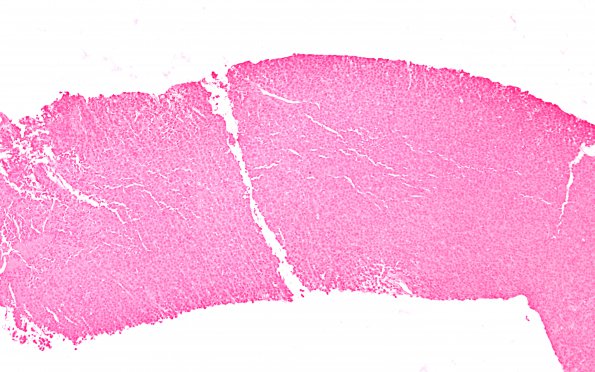 2D2 Plasmacytoma (Case 2) ISH Lambda 10X