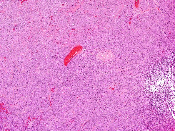 3B1 Plasma cell neoplasm (Case 3) 10X