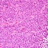 3B2 Plasma cell neoplasm (Case 3) H&E 4.jpg