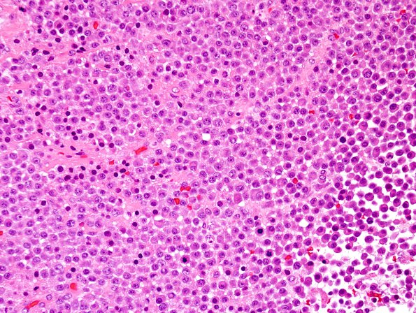 3B2 Plasma cell neoplasm (Case 3) H&E 4.jpg